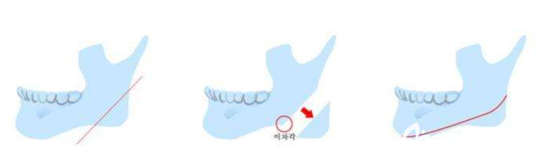 磨骨去下颌角留角好还是不留好