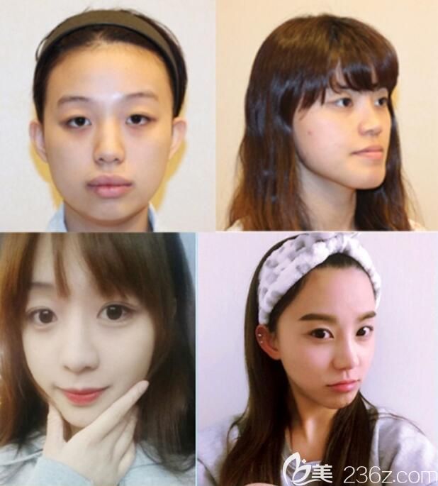 韩国菲斯莱茵双胞胎姐妹整形前后对比照片