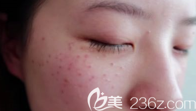 潍坊皮秒祛斑术后第4天的样子 潍坊皮秒祛斑术后第4天的样子