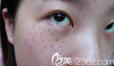 潍坊皮秒祛斑术前照片 潍坊皮秒祛斑术前照片