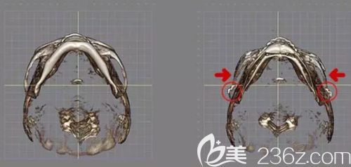 韩国面部轮廓三件套改善部位 韩国面部轮廓三件套改善部位
