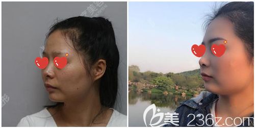 武汉美基元胡娟医生做皮秒激光祛斑术后效果