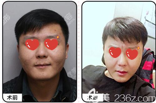 美基元祛痘套餐术后30天恢复14_1560505176614582.jpg 美基元祛痘套餐术后30天恢复14_1560505176614582.jpg