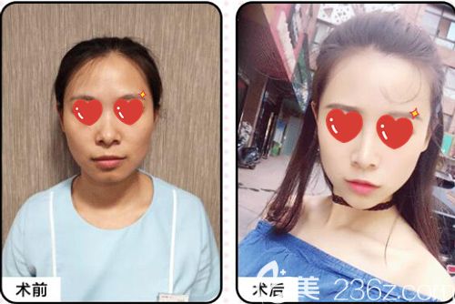 武汉美基元玻尿酸填充丰脸术前术后对比效果 武汉美基元玻尿酸填充丰脸术前术后对比效果