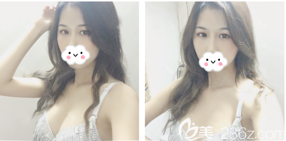 自体脂肪隆胸术后半个月恢复期图片 自体脂肪隆胸术后半个月恢复期图片