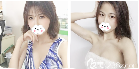 广州美莱<!--<i data=20240703-sp></i>-->做的自体脂肪隆胸手术<span style= 广州美莱<!--<i data=20240703-sp></i>-->做的自体脂肪隆胸手术<span style=