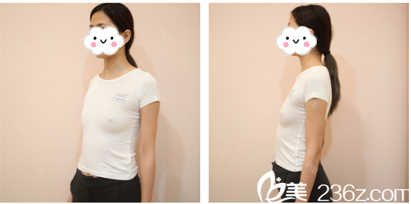 在广州美莱做隆胸术前照片 在广州美莱做隆胸术前照片