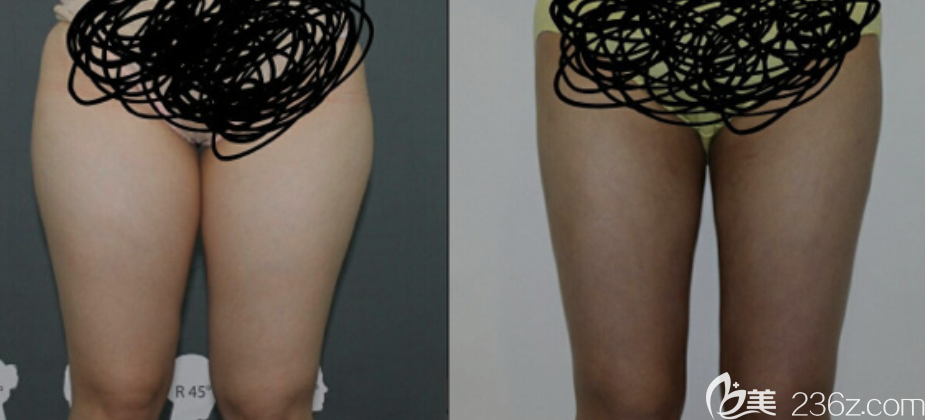 大腿吸脂抽了2900CC韩国丽颖整形外科安相泰术前大腿围60cm1个月53cm