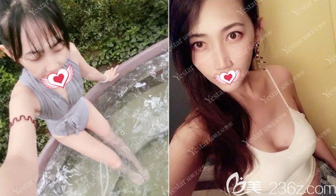 金辉做自体脂肪丰胸案例效果对比图