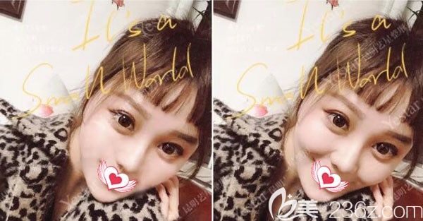 应许做自体脂肪面部填充苹果肌案例效果