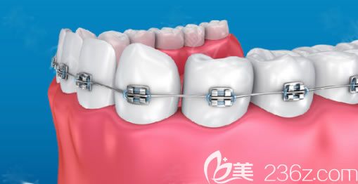 季清皎医生解答关于牙齿矫正的常见问题