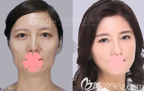 长春中妍奥拉克金学周面部年轻化前后效果对比图