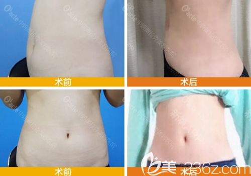 长春中妍奥拉克整形腰腹吸脂案例效果对比图