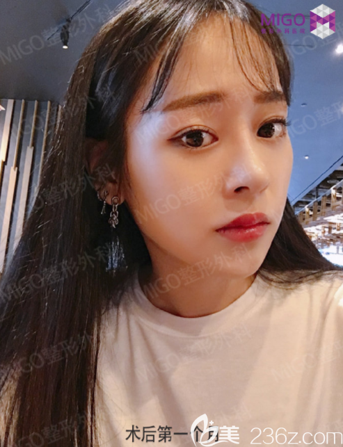 韩国migo姜垠宅硅胶隆鼻+埋线双眼皮3个月后看看我的变化，自己都吃惊