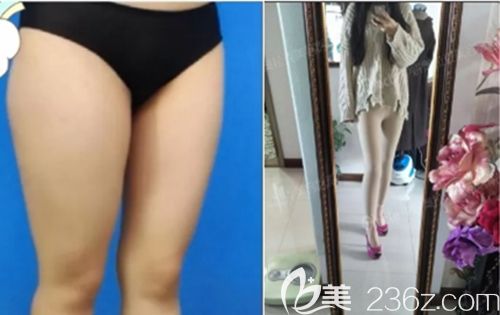 吸脂后穿塑身衣的效果图