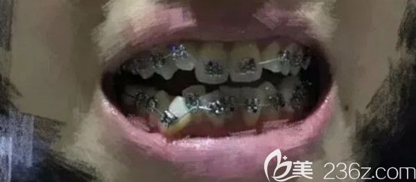 刚带上金属牙套的照片 刚带上金属牙套的照片