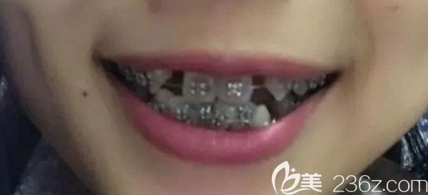 拔牙后带上金属牙套的样子 拔牙后带上金属牙套的样子