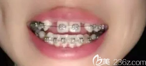 金属托槽矫正半个月的效果图 金属托槽矫正半个月的效果图