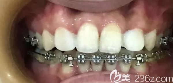 上牙做完牙贴面后的变化图 上牙做完牙贴面后的变化图