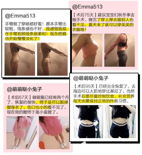 苏州紫馨吸脂案例 苏州紫馨吸脂案例