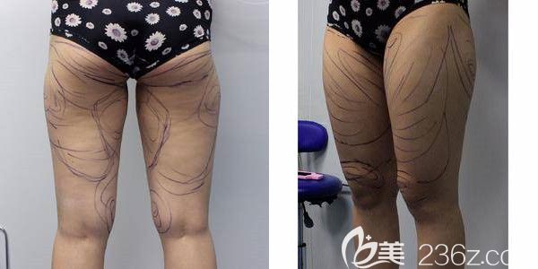 面诊苏州紫馨术前大腿较粗 面诊苏州紫馨术前大腿较粗