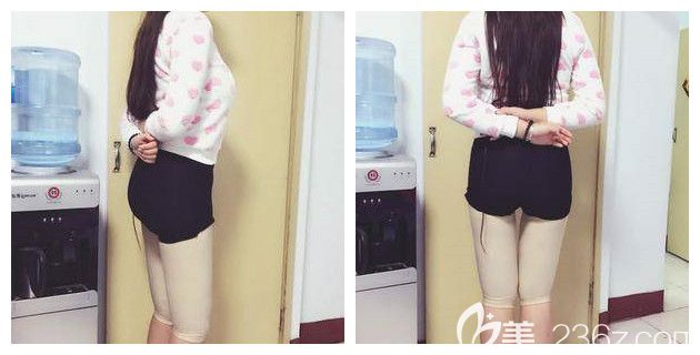 刚做完大腿吸脂术后恢复 刚做完大腿吸脂术后恢复