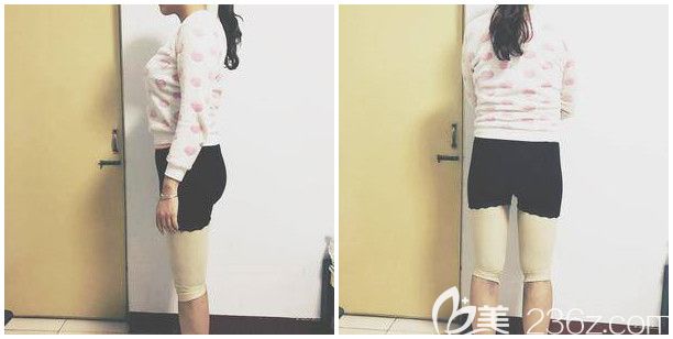 大腿和腿部吸脂一周后穿着塑身衣 大腿和腿部吸脂一周后穿着塑身衣