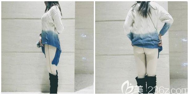 做完大腿吸脂+臀部吸脂术后半个月恢复 做完大腿吸脂+臀部吸脂术后半个月恢复