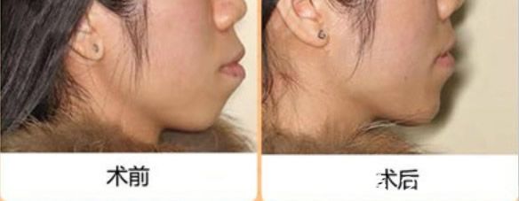 蔡灿医生成人龅牙凸嘴矫正前后对比图