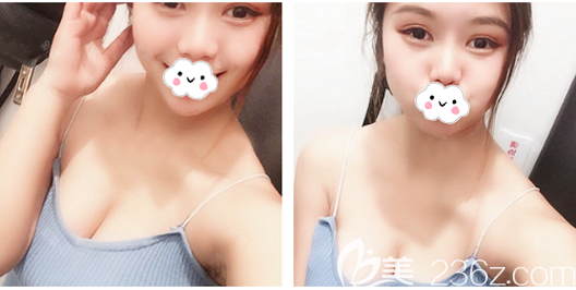 佛山华美雷朝勇院长假体隆胸案例