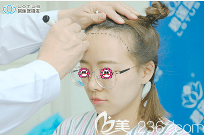 通过我在北京碧莲盛做发际线种植设计照来看之前样子 通过我在北京碧莲盛做发际线种植设计照来看之前样子