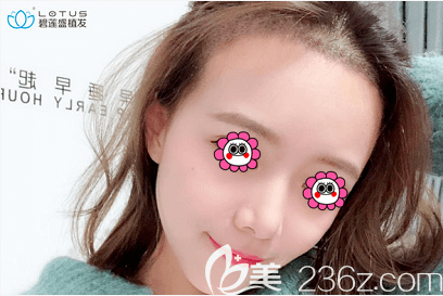 我在北京碧莲盛种植发际线改善额角光秃等问题第9天样子 我在北京碧莲盛种植发际线改善额角光秃等问题第9天样子