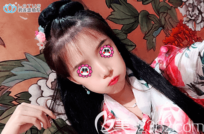 北京碧莲盛医生给我做发际线种植第5月样子 北京碧莲盛医生给我做发际线种植第5月样子