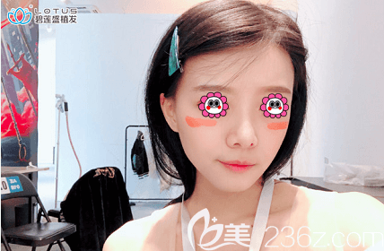 我在北京碧莲盛种植发际线第9个月效果 我在北京碧莲盛种植发际线第9个月效果