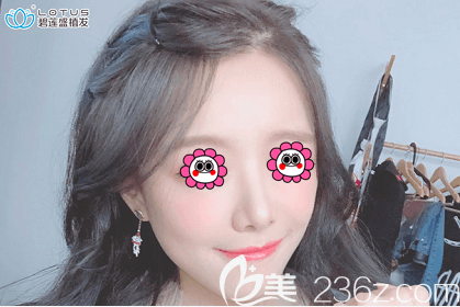 我在北京植发医院排名靠前的北京碧莲盛种植发际线后改善了额角光秃等问题