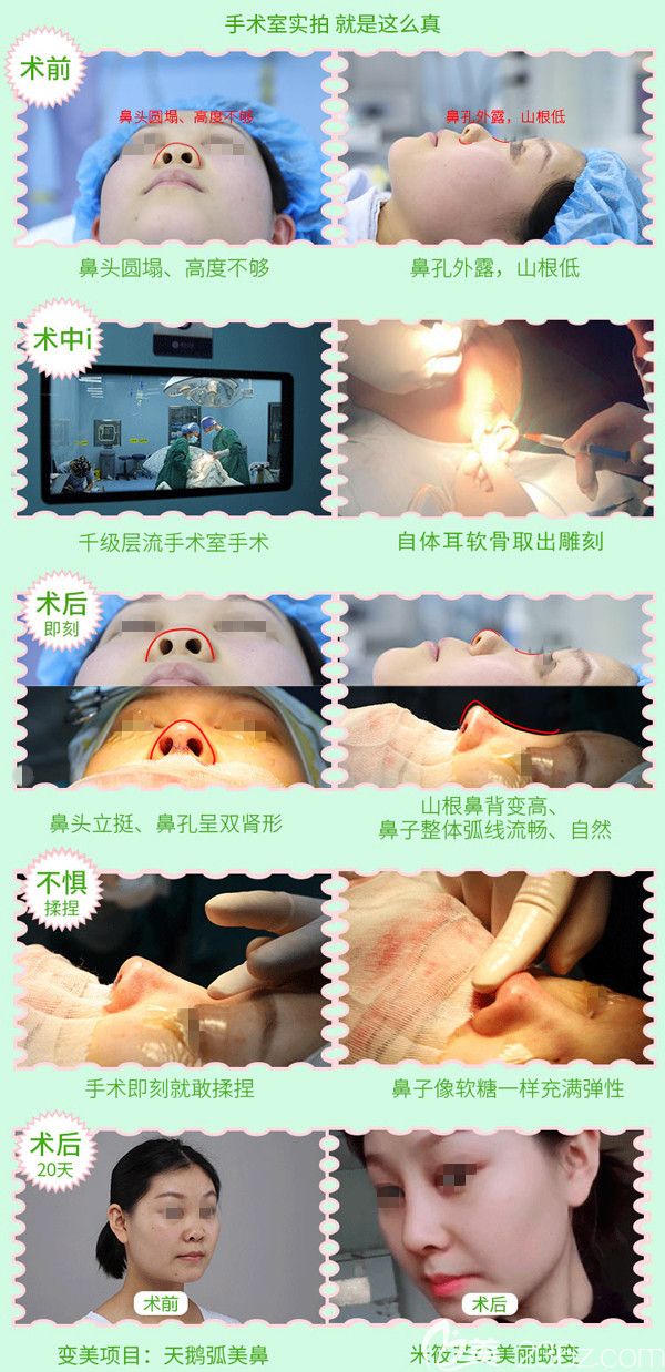 到连云港华美做鼻综合分享