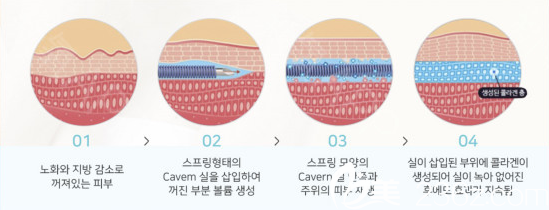 韩国纯真医院崔宰源cavern线原理