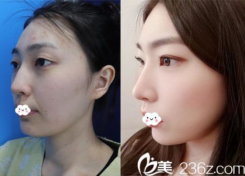 韩国纯真崔宰源院长线雕案例图片比对