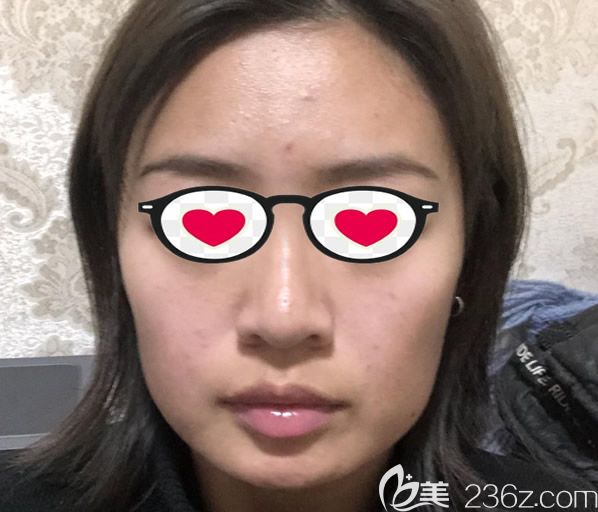 兰州崔大夫整形徐陇豫医生做全脸脂肪填充和硅胶垫下巴前 兰州崔大夫整形徐陇豫医生做全脸脂肪填充和硅胶垫下巴前