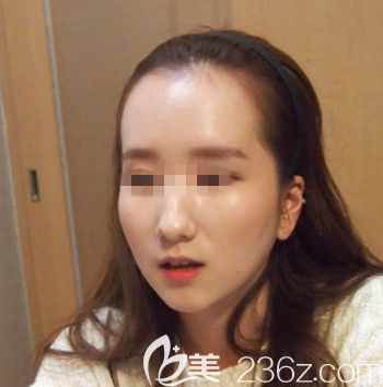 在韩国forhair做无切开发际线移植术前咨询 在韩国forhair做无切开发际线移植术前咨询