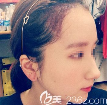 在韩国forhair做无切开发际线移植术后1天 在韩国forhair做无切开发际线移植术后1天