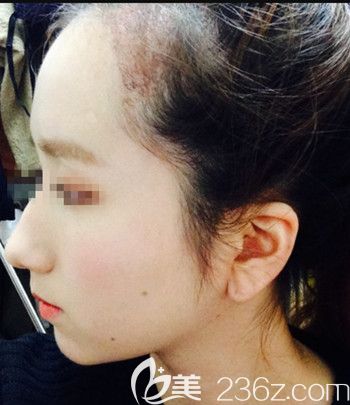 在韩国forhair做无切开发际线移植术后1个月 在韩国forhair做无切开发际线移植术后1个月