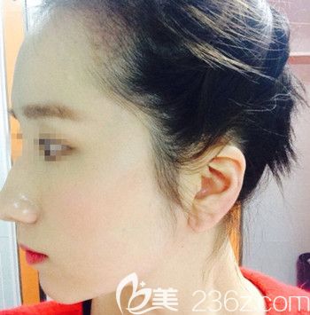 在韩国forhair做无切开发际线移植术后3个月 在韩国forhair做无切开发际线移植术后3个月