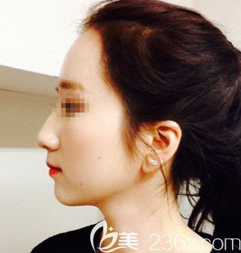 在韩国forhair做无切开发际线移植术后4个月 在韩国forhair做无切开发际线移植术后4个月