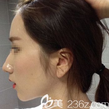 在韩国forhair做无切开发际线移植术后7个月 在韩国forhair做无切开发际线移植术后7个月