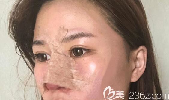 我在太原时光整形做膨体加自体耳软骨隆鼻第3天