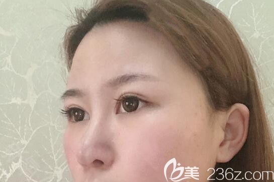 我在太原时光整形做鼻综合隆鼻术后第15天