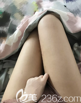 青岛华颜美做大腿吸脂手术真的很不错，看我恢复后的照片就知道了