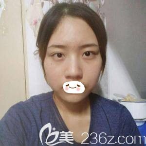 在张家口维多利亚注射玻尿酸术前面部凹陷 在张家口维多利亚注射玻尿酸术前面部凹陷