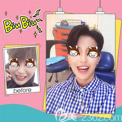 隐形牙齿矫正壹加壹真人案例术后恢复 隐形牙齿矫正壹加壹真人案例术后恢复